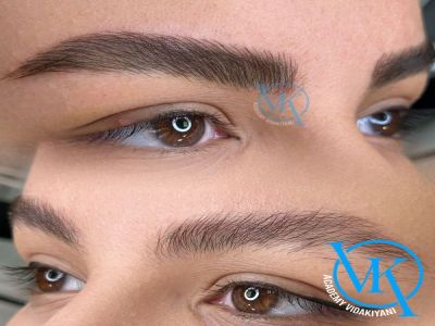 چند بار می توان فیبروز ابرو را تمدید کرد؟