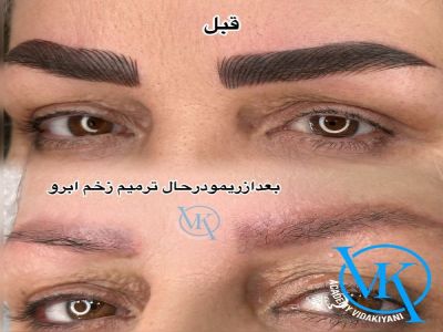 علت باقی ماندن هاله رنگ بعد از ریموو ابرو