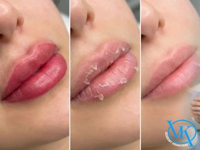 آیا بعد از کانتور لب پوسته‌ ریزی طبیعی است؟