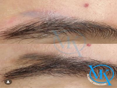 علت جوش زدن بعد از ریمو ابرو چیست؟
