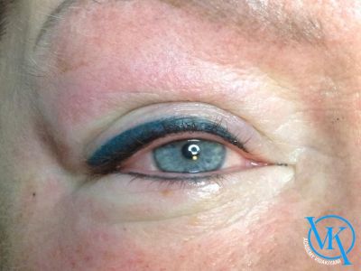 علت آبی شدن تاتو خط چشم