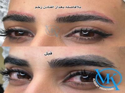 آیا ریمو ابرو درد دارد؟