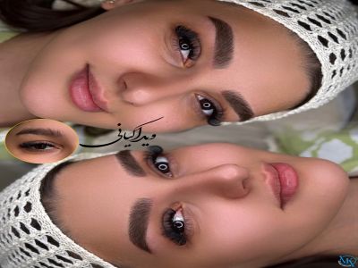 آیا فیبروز ابرو درد دارد؟