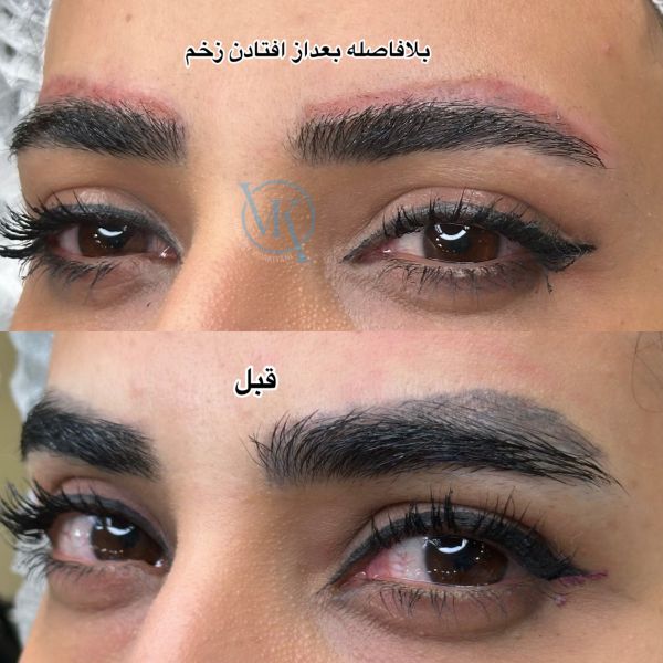 مراقبت های بعد ریموو ابرو