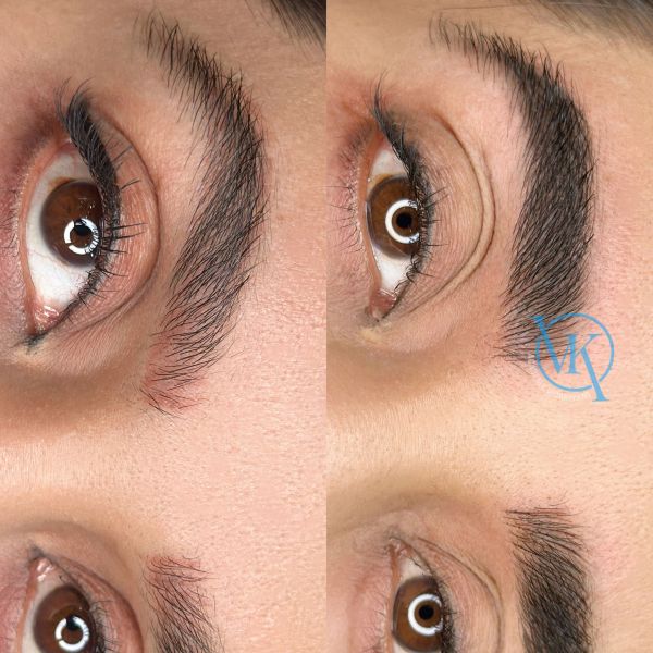 فیبروز ابرو