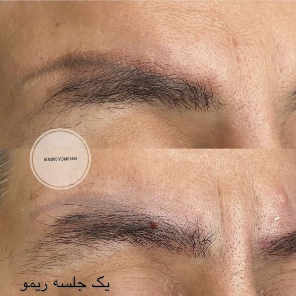 مراقبت های بعد ریموو ابرو