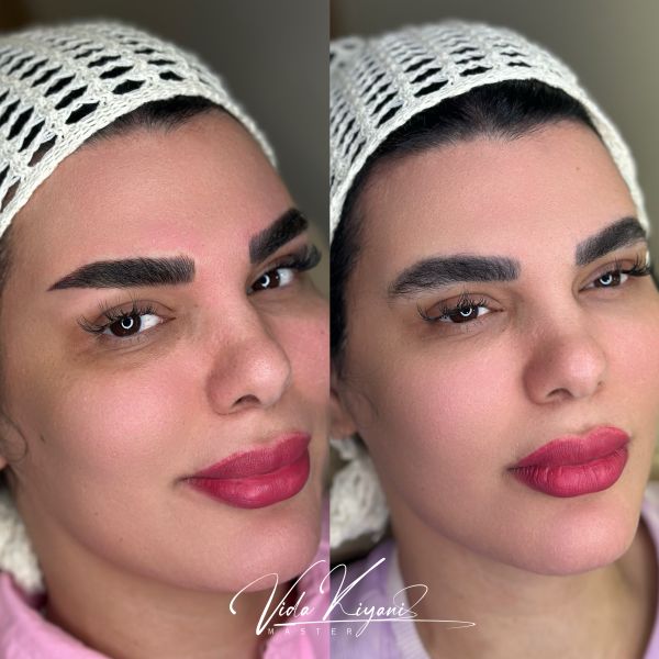 هایپرلیفت ابرو